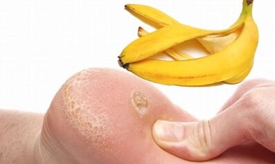 Bananų žievelės, skirtos padalos karpos gydymui
