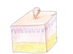 kaip atsikratyti papilomos ant kūno