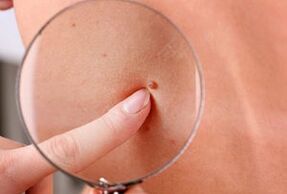 papilomų atsiradimo ant žmogaus kūno priežastys