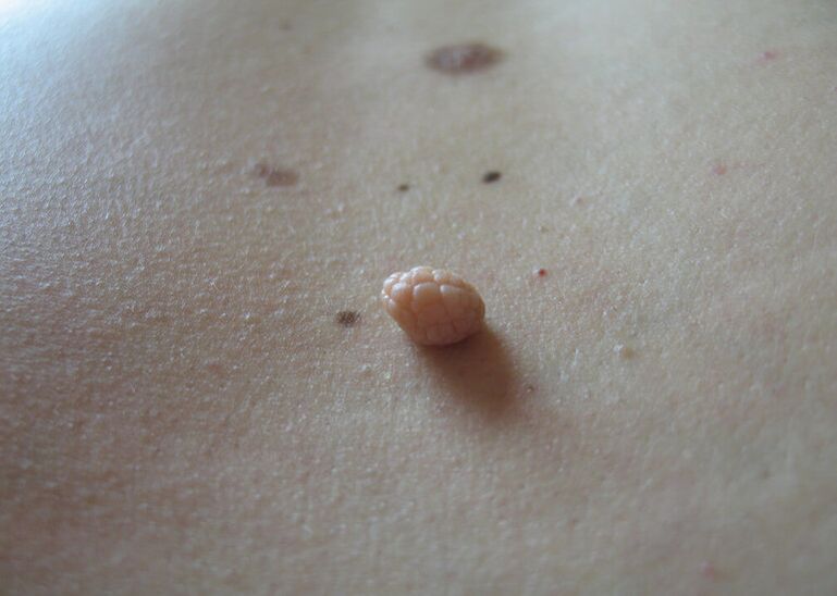 papilomos ant žmogaus kūno